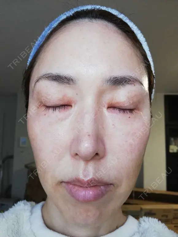 ピーリング（ハリ・ツヤ） まゆりなclinic 名古屋栄 AFTER メイン用