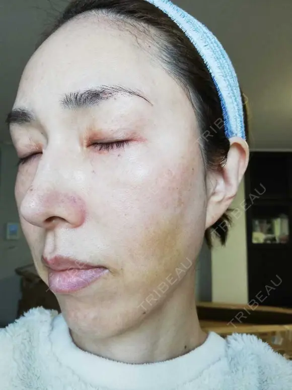 ピーリング（ハリ・ツヤ） まゆりなclinic 名古屋栄 DAY 3 メイン用