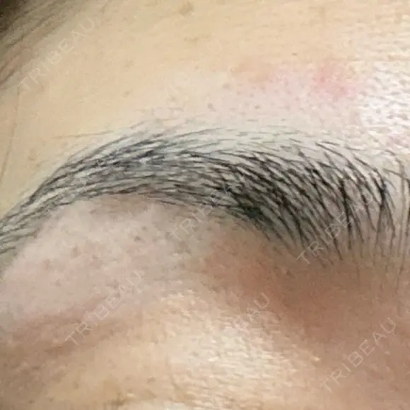 医療脱毛（顔） Jスキンクリニック 【J-SKIN clinic】 DAY 1 メイン用