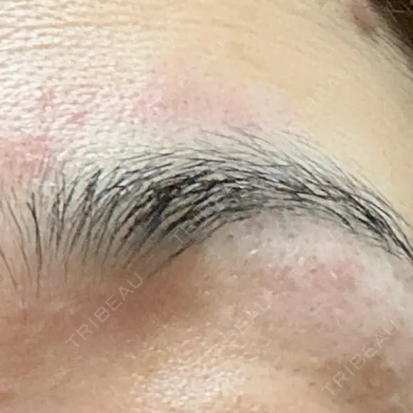 医療脱毛（顔） Jスキンクリニック 【J-SKIN clinic】 DAY 1 メイン用