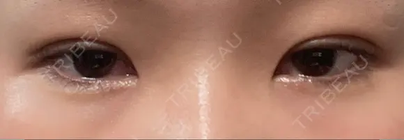 二重埋没 水の森美容クリニック 東京銀座院 DAY 3 メイン用