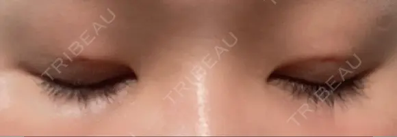 二重埋没 水の森美容クリニック 東京銀座院 DAY 3 メイン用