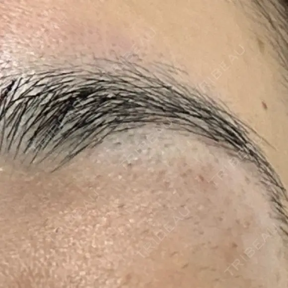 医療脱毛（顔） Jスキンクリニック 【J-SKIN clinic】 DAY 2 メイン用