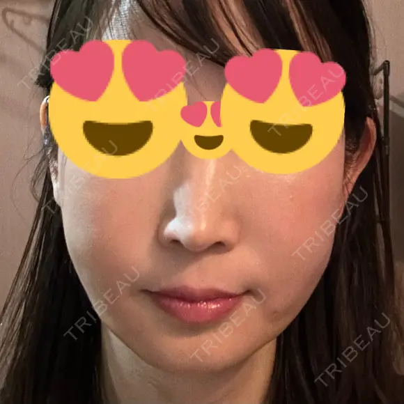 クマ治療 / 脂肪注入（肌） / 脂肪注入（目の下） EMMO FACE CLINIC 大宮院 DAY 14 メイン用