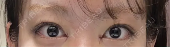 目頭切開 / 美容点滴・美容注射（疲労回復） HAAB×DREAM BEAUTY CLINIC 大阪梅田院 DAY 0 メイン用