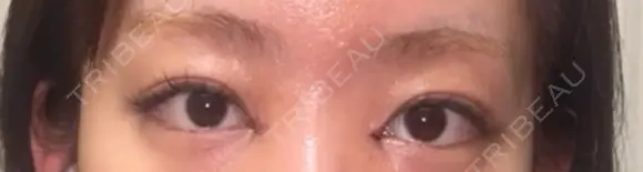 目頭切開 / 美容点滴・美容注射（疲労回復） HAAB×DREAM BEAUTY CLINIC 大阪梅田院 DAY 2 メイン用