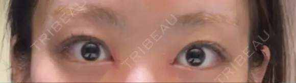 目頭切開 / 美容点滴・美容注射（疲労回復） HAAB×DREAM BEAUTY CLINIC 大阪梅田院 DAY 5 メイン用