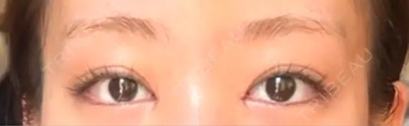 目頭切開 / 美容点滴・美容注射（疲労回復） HAAB×DREAM BEAUTY CLINIC 大阪梅田院 DAY 8 メイン用