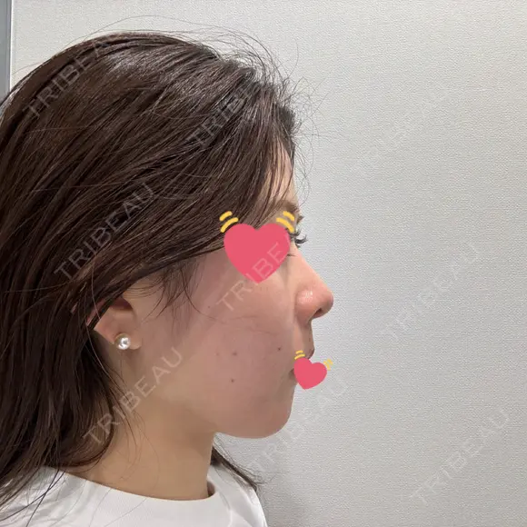 隆鼻術 / 鼻中隔延長（切開） / 鼻翼基部形成（貴族手術） ヴェリテクリニック 銀座院 DAY 43 メイン用