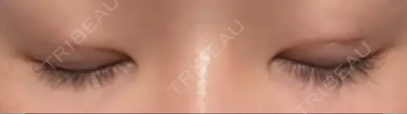 二重埋没 水の森美容クリニック 東京銀座院 DAY 5 メイン用