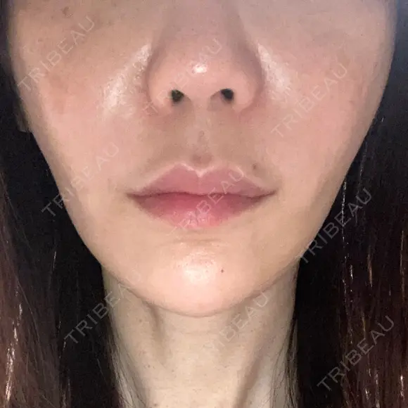 糸リフト / 脂肪吸引（顔） / ボトックス（エラ・小顔） / ヒアルロン酸注入（頬） Tokyo Tensei Clinic 新宿院 DAY 21 メイン用