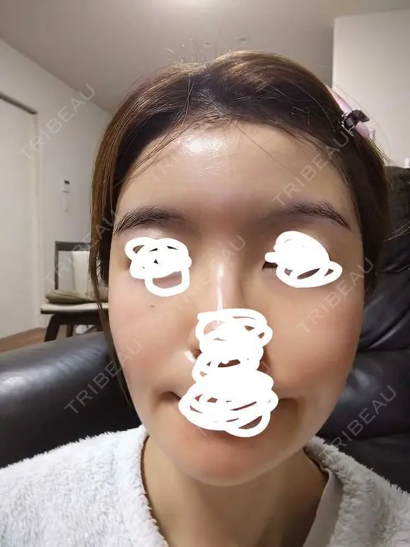 ヒアルロン酸注入（額） / ヒアルロン酸注入（こめかみ） LA CLEF CLINIC（ラクレクリニック） DAY 8 メイン用