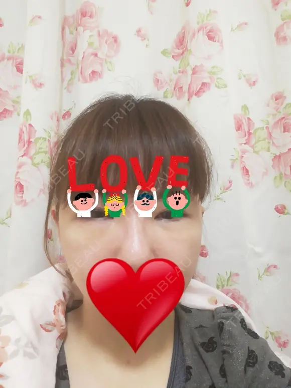 切開リフト こうべ花時計クリニック DAY 14 メイン用
