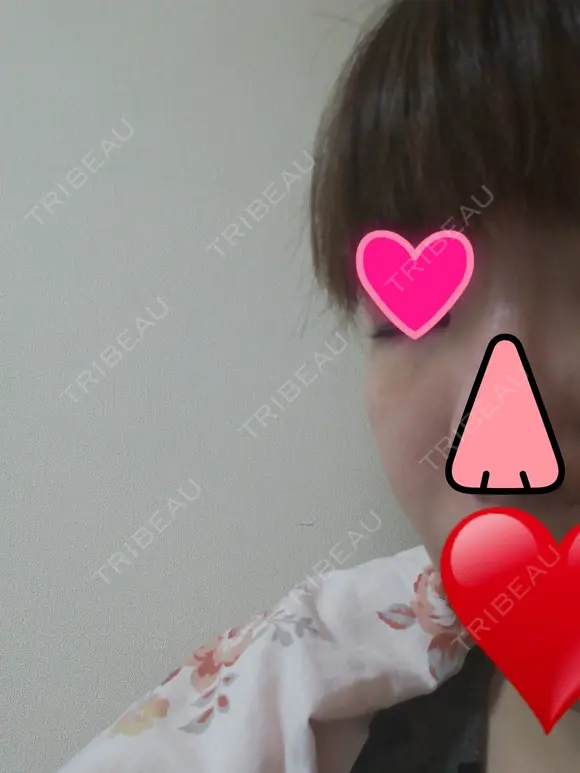 切開リフト こうべ花時計クリニック DAY 14 メイン用