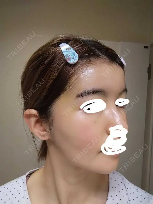 ヒアルロン酸注入（額） / ヒアルロン酸注入（こめかみ） LA CLEF CLINIC（ラクレクリニック） DAY 9 メイン用