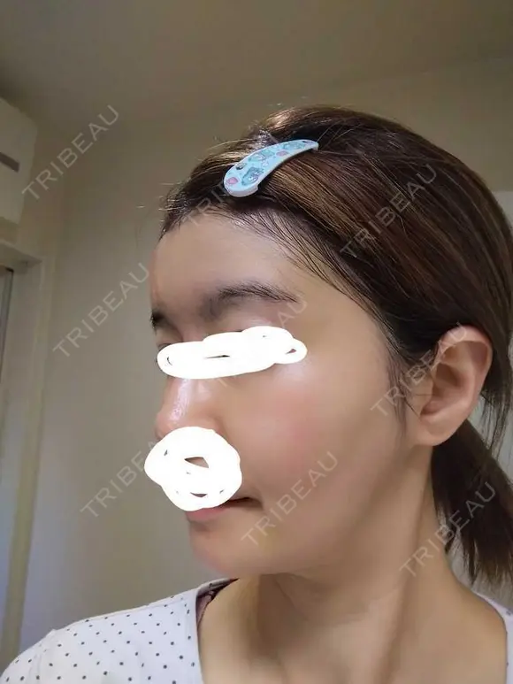 ヒアルロン酸注入（額） / ヒアルロン酸注入（こめかみ） LA CLEF CLINIC（ラクレクリニック） DAY 9 メイン用