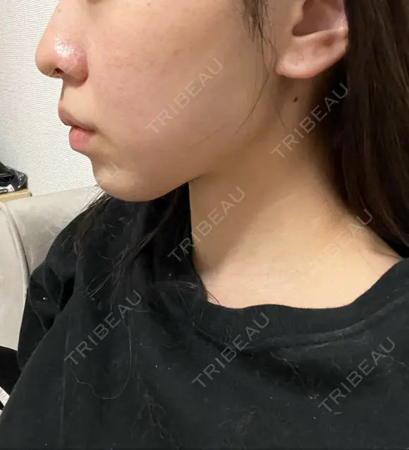 ピーリング（ニキビ・毛穴） / 光治療（フォトフェイシャルなど） RAISE CLINIC 【レイズクリニック】 AFTER メイン用