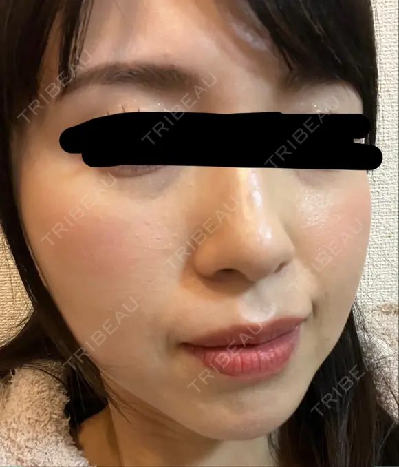 イオン導入 椿クリニック 名古屋院 DAY 5 メイン用