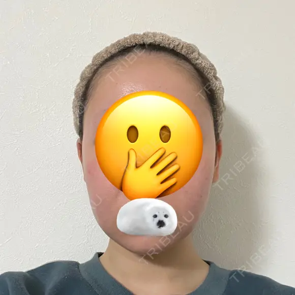 脂肪吸引（顔） 札幌ル・トロワ ビューティクリニックVogue DAY 35 メイン用