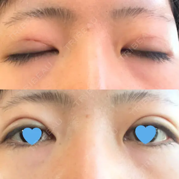 二重埋没 / ハイフ（顔） 日本ウェルネス再生クリニック AFTER メイン用