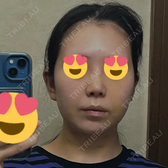 鼻尖形成（切開） / 小鼻縮小（切開） / 脂肪吸引（顔） / 軟骨移植 / 骨切幅寄せ / 鼻尖縮小 / 鼻柱挙上 銀座マイアミ美容外科 DAY 8 メイン用