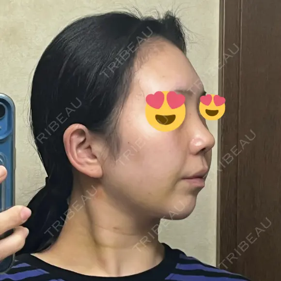 鼻尖形成（切開） / 小鼻縮小（切開） / 脂肪吸引（顔） / 軟骨移植 / 骨切幅寄せ / 鼻尖縮小 / 鼻柱挙上 銀座マイアミ美容外科 DAY 8 メイン用