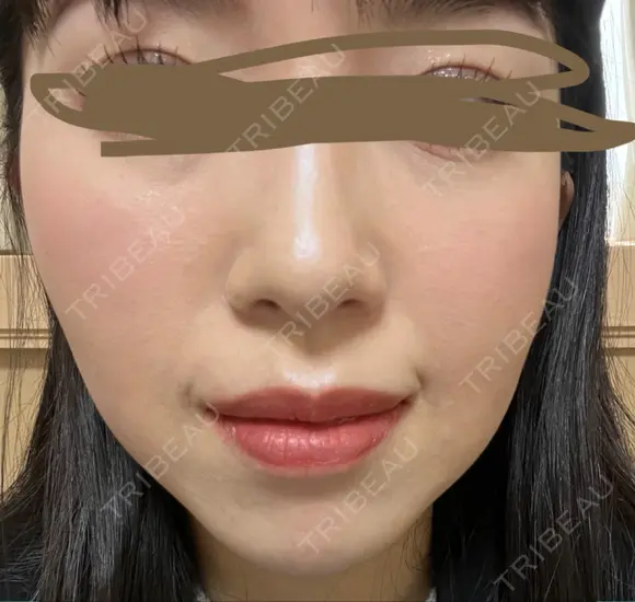 イオン導入 椿クリニック 名古屋院 DAY 8 メイン用