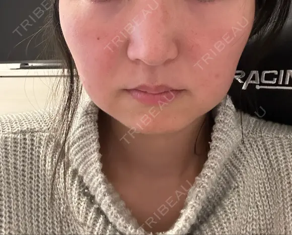 ダーマペン LIFIX BEAUTY CLINIC DAY 1 メイン用