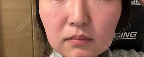 ダーマペン LIFIX BEAUTY CLINIC DAY 2 メイン用