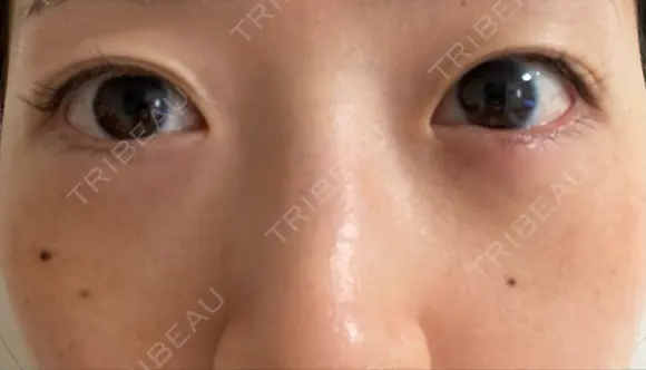 下まぶたたるみ取り / 下まぶたの脂肪取り 湘南美容クリニック 京都院 DAY 7 メイン用