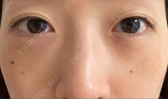 下まぶたたるみ取り / 下まぶたの脂肪取り 湘南美容クリニック 京都院 DAY 5 メイン用