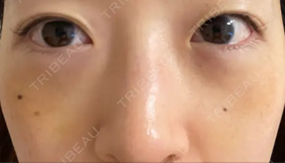 下まぶたたるみ取り / 下まぶたの脂肪取り 湘南美容クリニック 京都院 DAY 4 メイン用