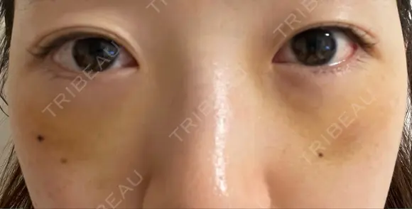 下まぶたたるみ取り / 下まぶたの脂肪取り 湘南美容クリニック 京都院 DAY 3 メイン用