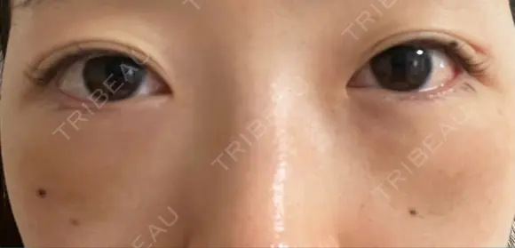 下まぶたたるみ取り / 下まぶたの脂肪取り 湘南美容クリニック 京都院 DAY 2 メイン用