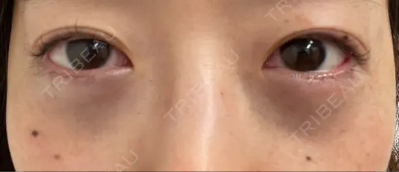 下まぶたたるみ取り / 下まぶたの脂肪取り 湘南美容クリニック 京都院 DAY 0 メイン用