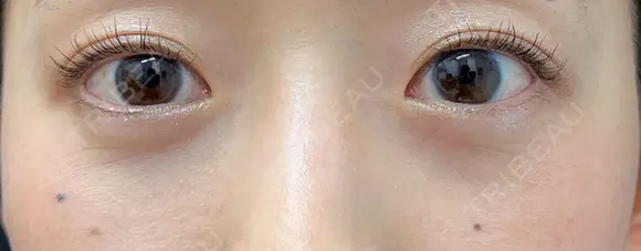 下まぶたたるみ取り / 下まぶたの脂肪取り 湘南美容クリニック 京都院 AFTER メイン用