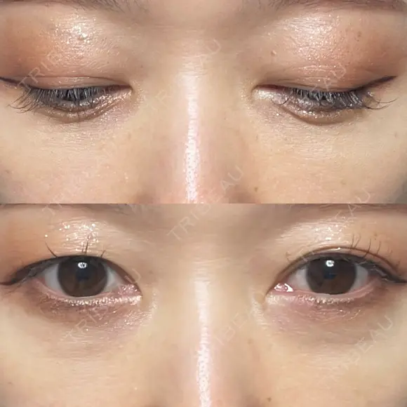 下まぶたの脂肪取り Brandnew Beauty Clinic DAY 14 メイン用