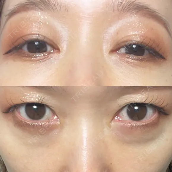 下まぶたの脂肪取り Brandnew Beauty Clinic DAY 14 メイン用