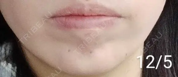 ボトックス（あご） 湘南美容クリニック 宇都宮院 DAY 10 メイン用