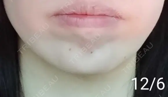 ボトックス（あご） 湘南美容クリニック 宇都宮院 DAY 11 メイン用