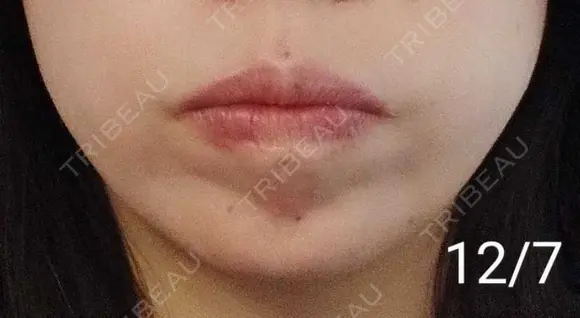 ボトックス（あご） 湘南美容クリニック 宇都宮院 DAY 12 メイン用
