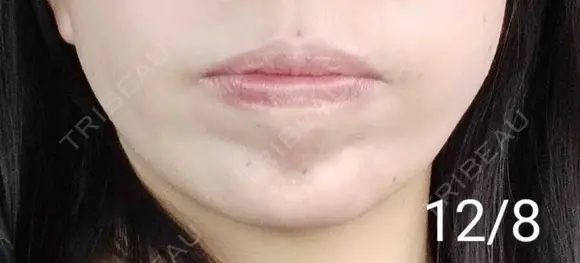 ボトックス（あご） 湘南美容クリニック 宇都宮院 DAY 13 メイン用