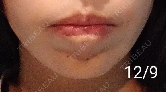 ボトックス（あご） 湘南美容クリニック 宇都宮院 DAY 14 メイン用