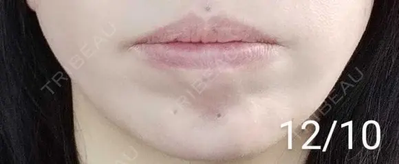 ボトックス（あご） 湘南美容クリニック 宇都宮院 DAY 15 メイン用