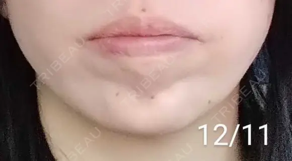 ボトックス（あご） 湘南美容クリニック 宇都宮院 DAY 16 メイン用