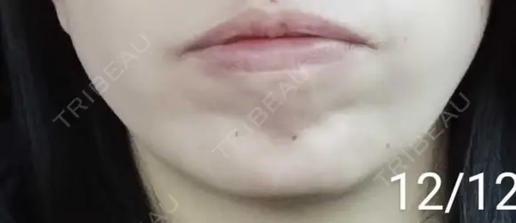 ボトックス（あご） 湘南美容クリニック 宇都宮院 DAY 17 メイン用