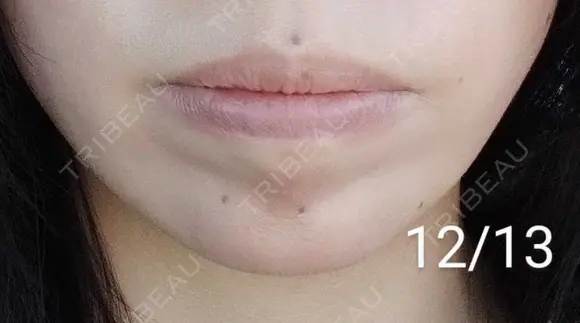 ボトックス（あご） 湘南美容クリニック 宇都宮院 AFTER メイン用