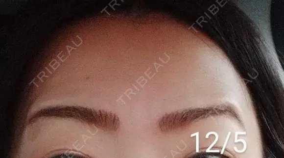 ボトックス（額） 湘南美容クリニック 宇都宮院 DAY 10 メイン用