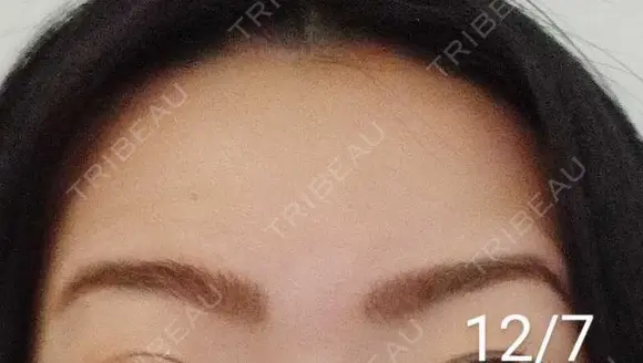 ボトックス（額） 湘南美容クリニック 宇都宮院 DAY 12 メイン用