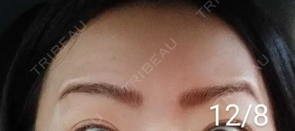 ボトックス（額） 湘南美容クリニック 宇都宮院 DAY 13 メイン用